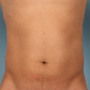 After This Atlanta man chose CoolSculpting to contour his abs and waist. He is shown about 2 months after his treatment. thumbnail