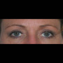 After This 50 year old female wanted a more “open” look to her eyes.  She had an upper blepharoplasty to remove excess skin and fat from her upper eyelids.  Her “after” photos were taken about 1 year after surgery. thumbnail
