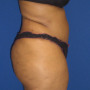 After This Georgia mom had an abdominoplasty (tummy tuck)  to remove loose skin and tighten her tummy muscles. She also had liposuction of her waist at the same time.  She is shown about 6 years after surgery. thumbnail