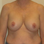 After This woman desired fuller breasts and needed a lift at the same time. We used 390 cc gel implants beneath the muscle. Her “after” photos were taken about 5 years after her surgery. thumbnail