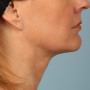 After Another beautiful necklift result from Dr. Kavali. thumbnail