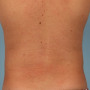 After This Atlanta man chose CoolSculpting to contour his abs and waist. He is shown about 2 months after his treatment. thumbnail
