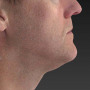 After Note the improved contour of the jawline and the decreased fullness under the chin after an Ulthera treatment. thumbnail