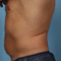 After This Atlanta male chose CoolSculpting to contour his abdomen and waist. He is shown before and about 2 months after his treatment. He completed 3 treatment cycles thumbnail