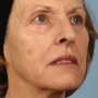 After This 68 year old Atlanta woman had a consultation with Dr. Kavali for facial rejuvenation.  Together, they decided that a variety of fillers would be best.  She had 4 syringes of Voluma in her cheeks, a syringe of Restylane Silk in her lips and around her mouth for the fine lines, and a syringe of Juvederm Ultra Plus in the nasolabial folds (smile lines). She is shown about 2 weeks after her treatment was done. thumbnail