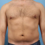 After This Atlanta male chose CoolSculpting to contour his abdomen and waist. He is shown before and about 2 months after his treatment. He completed 3 treatment cycles thumbnail