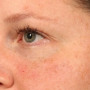 After After 1 syringe of Juvederm Vollure and 1 syringe of Juvederm Ultra to correct undereye hollows thumbnail