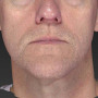 After A slimmer, more taut jawline is shown here after an Ultherapy treatment. thumbnail