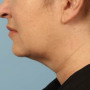 After Results after two Kybella treatments thumbnail