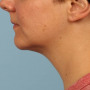 After Results after two Kybella treatments thumbnail
