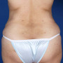 After This 30 year old female desired more buttock shape, as well as a smaller waist.  Dr. Kavali accomplished these two things by removing fat from her abdomen and waist, then transferring it (fat grafting) to both buttocks and hips.  Note that the remaining loose skin in her abdomen will be addressed by an abdominoplasty (tummy tuck) in the future, as part of this woman’s overall surgical plan. thumbnail