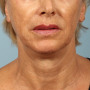 After A tighter, lifted neck and jawline after Ultherapy at Kavali Plastic Surgery thumbnail