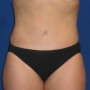 After This Atlanta mom had an abdominoplasty (tummy tuck) to remove loose skin and tighten her tummy muscles. She also had liposuction of her waist at the same time.  She is shown about 1 year after surgery. thumbnail