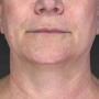 After Ulthera gave this woman an amazing result!  No other treatments were done.  Ulthera alone is responsible for this tighter, slimmer neck and jawline! thumbnail
