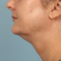 After Results after 3 Kybella Treatments thumbnail