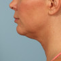 After Results after 3 Kybella treatments thumbnail
