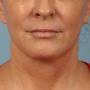 After A smoother, tighter jawline, neck and lower face after a facelift and necklift.  The after photo is about 1 year after surgery. thumbnail