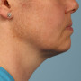 After Shown after a single treatment with Kybella thumbnail