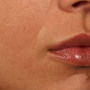 After After 1 syringe of Juvederm Ultra Plus to lips thumbnail