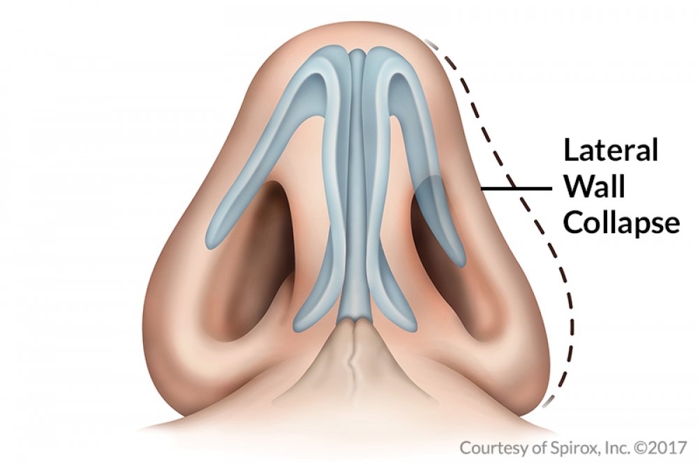 nasal obstruction