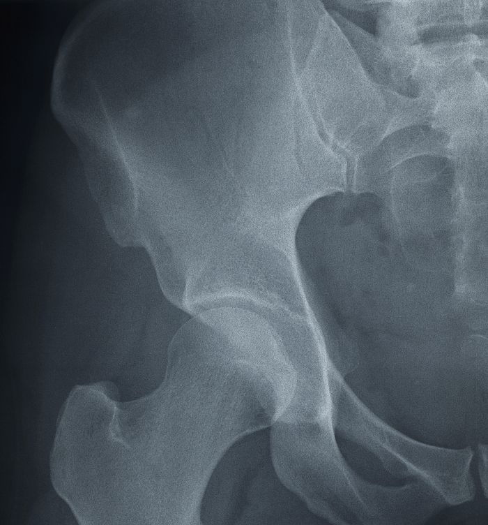 When Should You See a Hip Doctor?