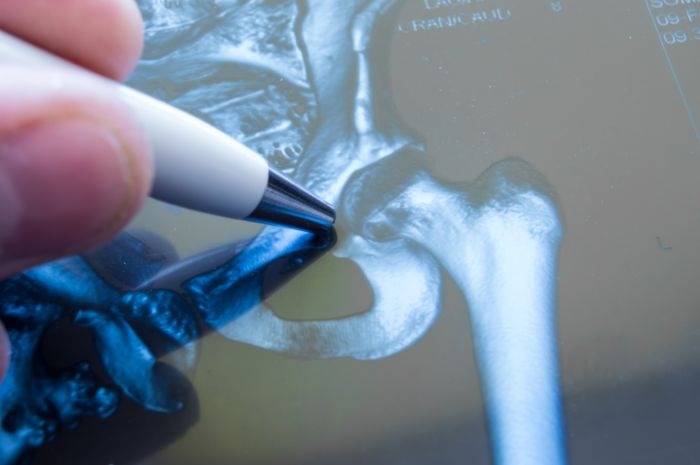 How Resurgens Diagnoses Hip Pain